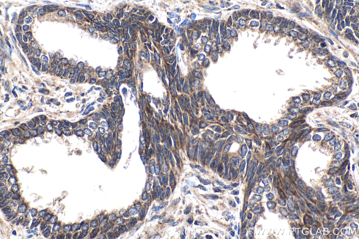 Immunohistochemical analysis of paraffin-embedded human prostate cancer tissue slide using KHC1441 (SMAD9 IHC Kit).