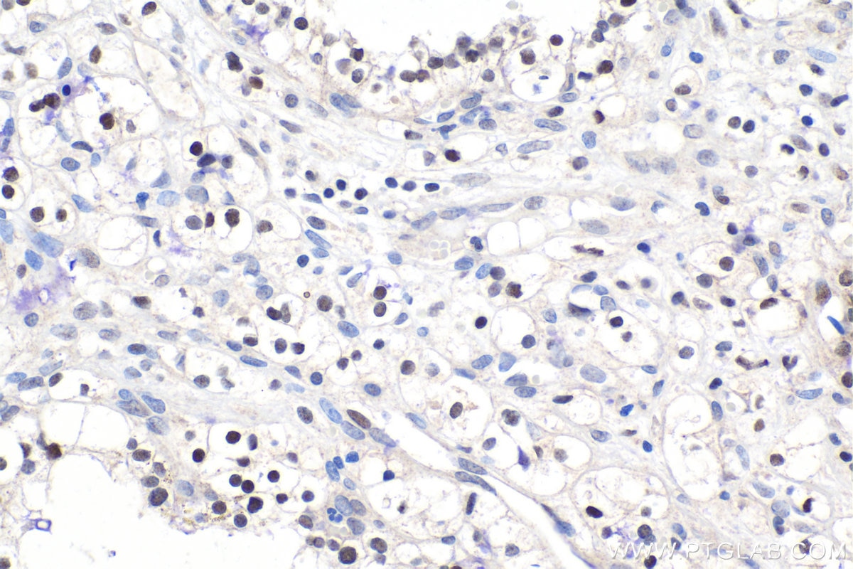 Immunohistochemical analysis of paraffin-embedded human renal cell carcinoma tissue slide using KHC1574 (SMARCA1/SNF2L IHC Kit).