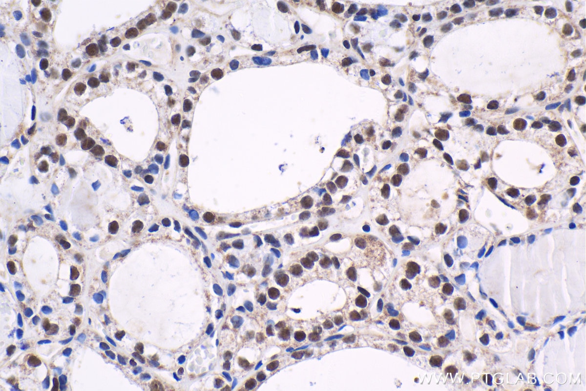 Immunohistochemical analysis of paraffin-embedded human thyroid cancer tissue slide using KHC1618 (SMARCA2 IHC Kit).