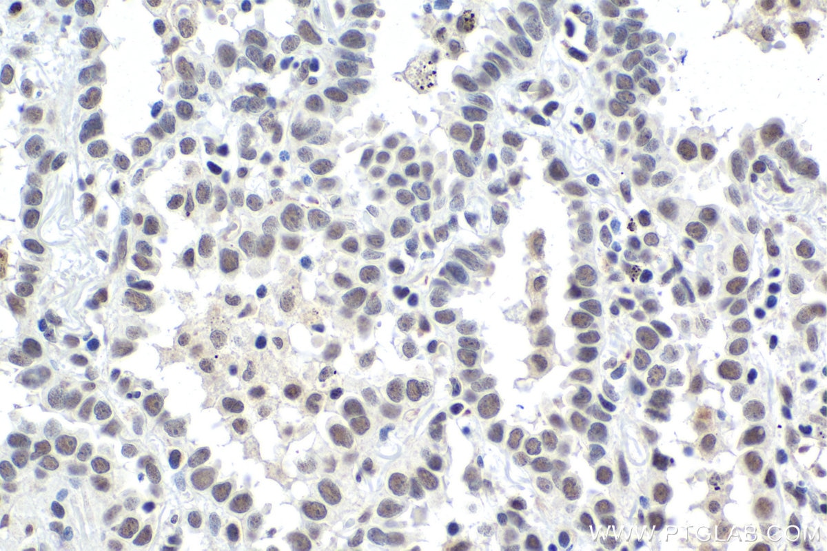 Immunohistochemical analysis of paraffin-embedded human lung cancer tissue slide using KHC1463 (SMARCA5 IHC Kit).