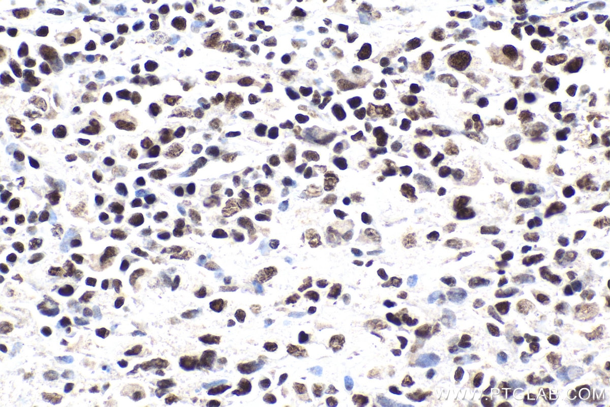 Immunohistochemical analysis of paraffin-embedded human malignant melanoma tissue slide using KHC1860 (SMARCC1 IHC Kit).