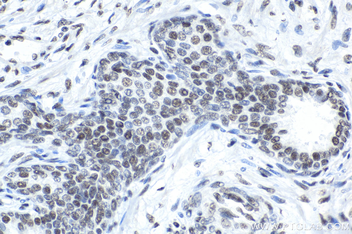 Immunohistochemical analysis of paraffin-embedded human prostate cancer tissue slide using KHC1398 (SMARCC2 IHC Kit).