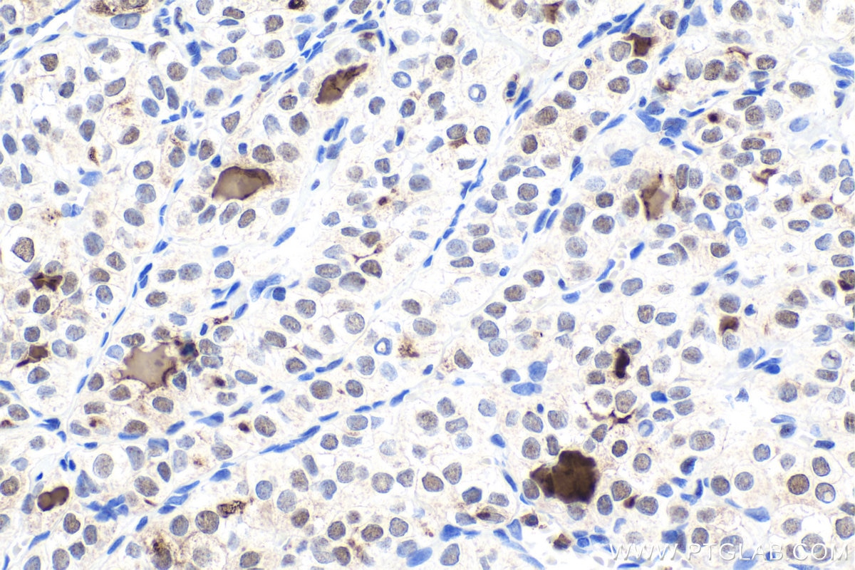Immunohistochemical analysis of paraffin-embedded human thyroid cancer tissue slide using KHC1791 (SMARCD3 IHC Kit).