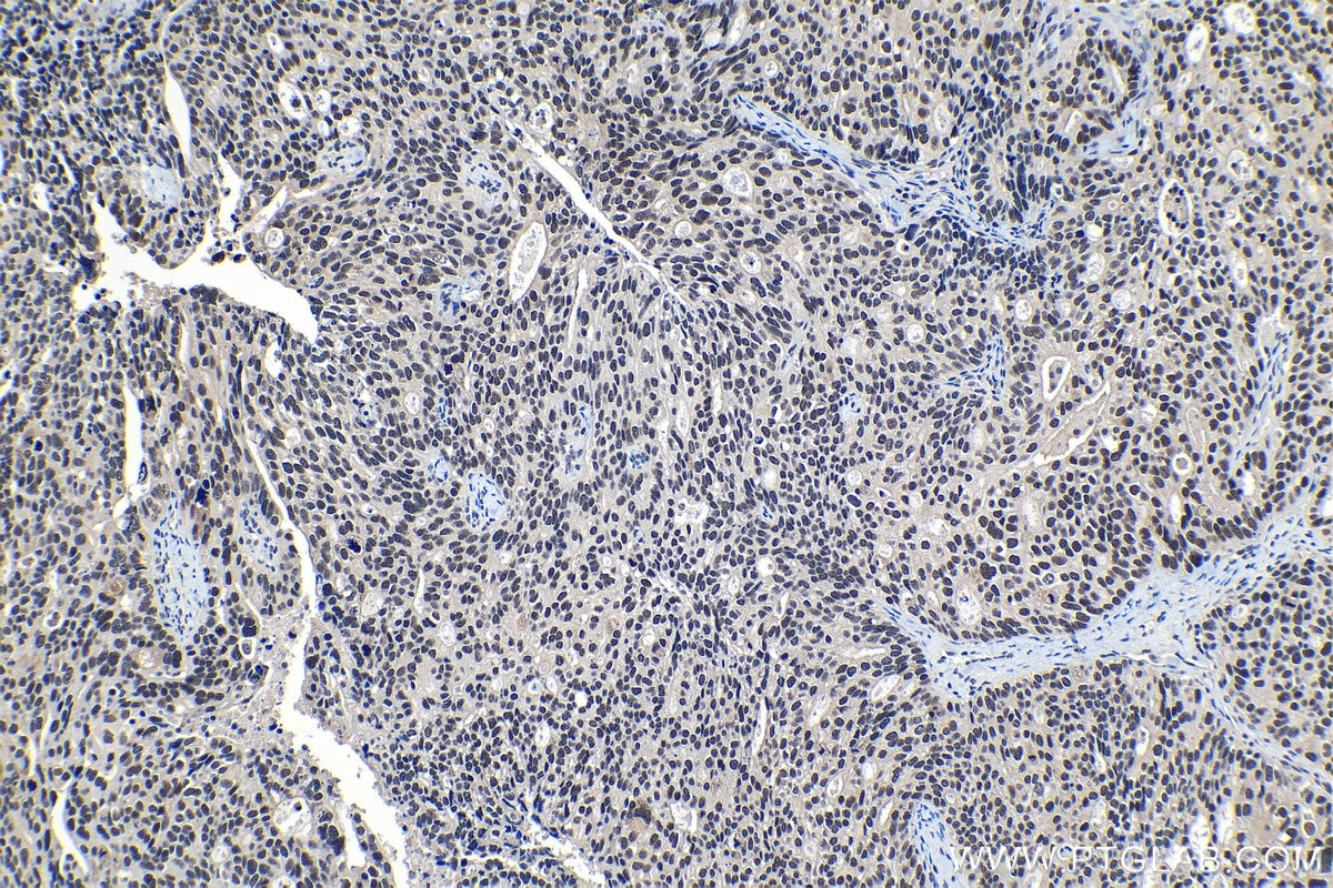 Immunohistochemical analysis of paraffin-embedded human ovary tumor tissue slide using KHC1212 (SMARCE1 IHC Kit).