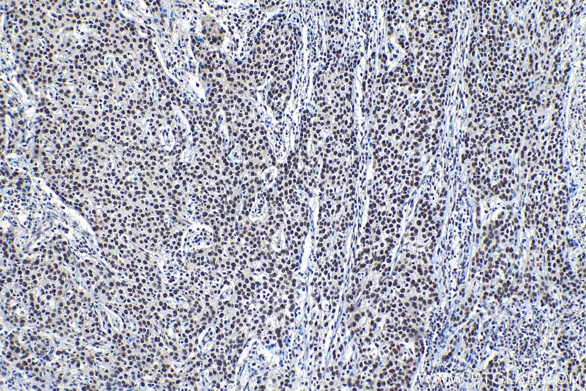 Immunohistochemical analysis of paraffin-embedded human cervical cancer tissue slide using KHC1212 (SMARCE1 IHC Kit).