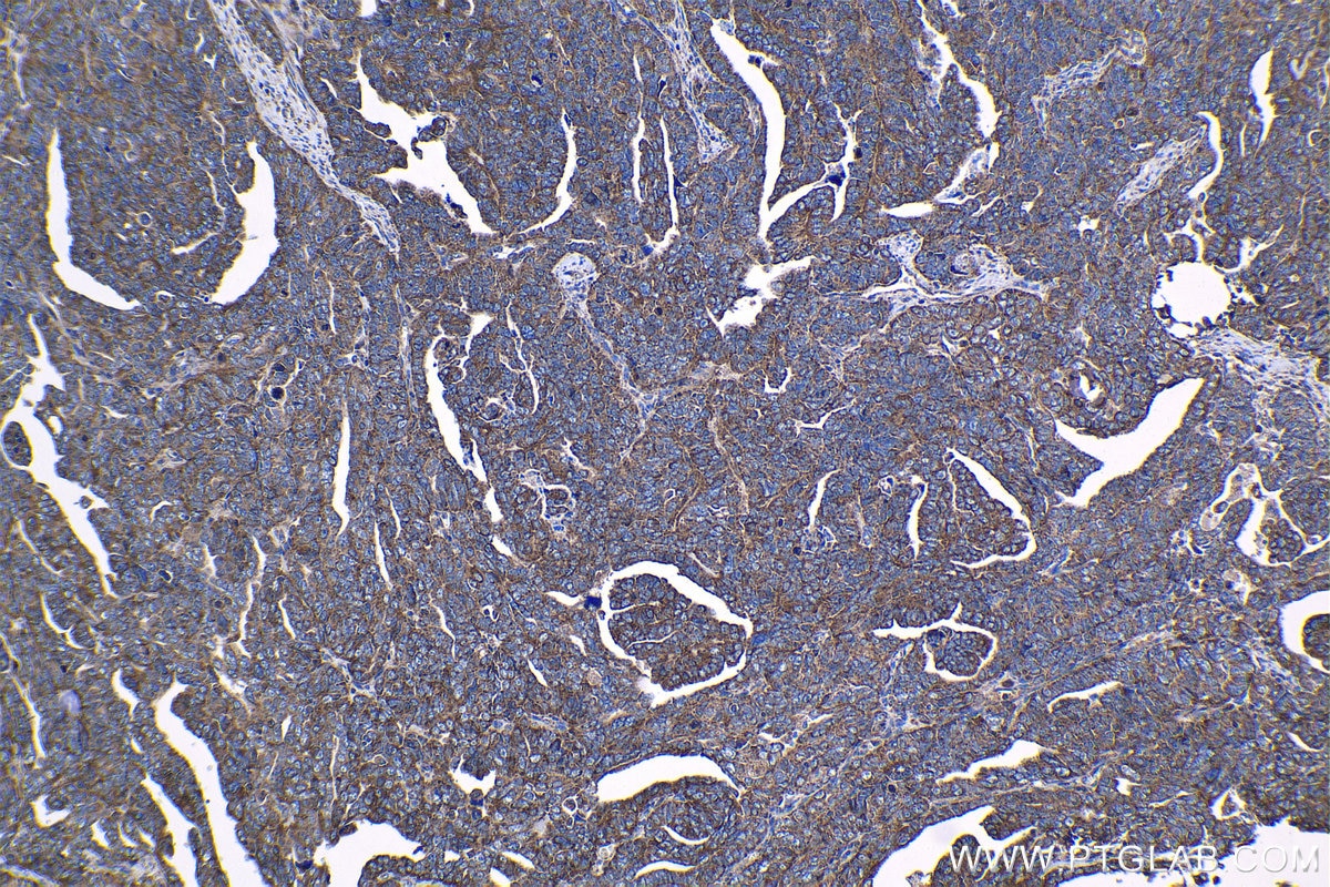 Immunohistochemical analysis of paraffin-embedded human ovary tumor tissue slide using KHC1221 (SMC4 IHC Kit).