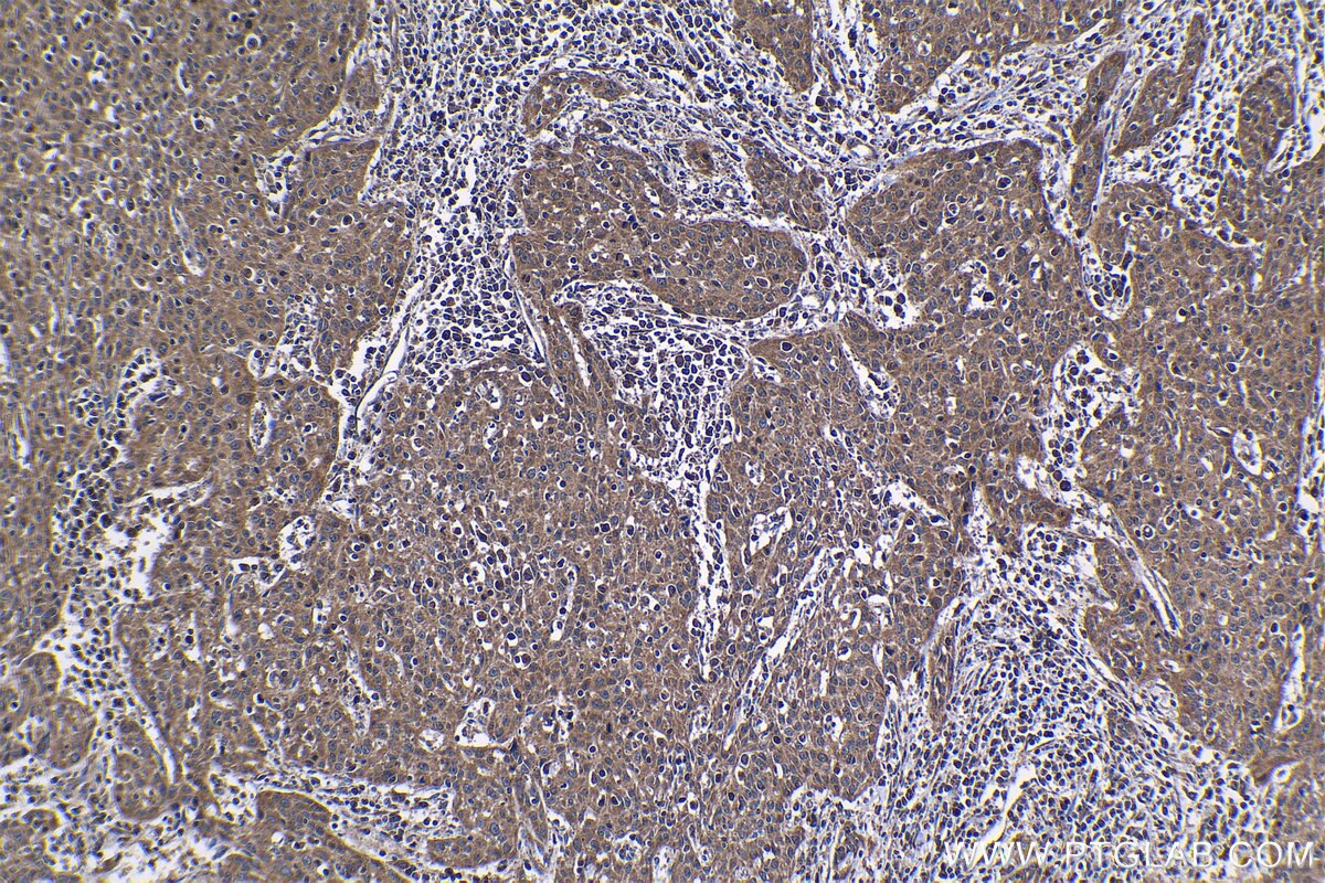 Immunohistochemical analysis of paraffin-embedded human cervical cancer tissue slide using KHC1221 (SMC4 IHC Kit).