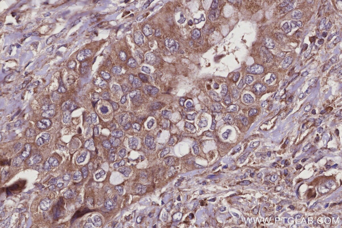 Immunohistochemical analysis of paraffin-embedded human pancreas cancer tissue slide using KHC2942 (SMCR7L/MID51 IHC Kit).