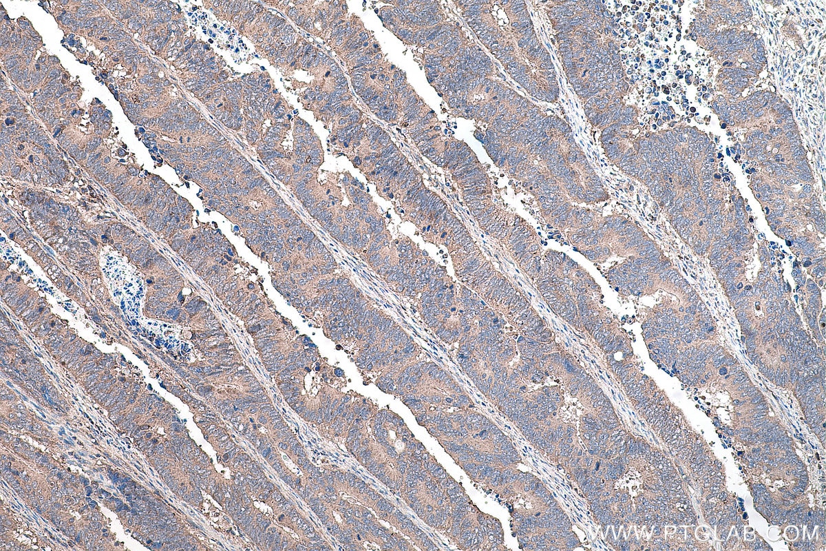 Immunohistochemical analysis of paraffin-embedded human colon cancer tissue slide using KHC0138 (SMO IHC Kit).