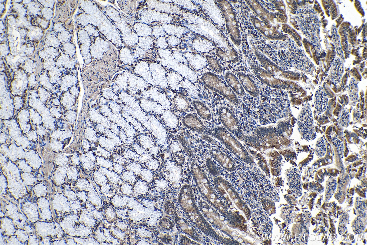 Immunohistochemical analysis of paraffin-embedded human stomach cancer tissue slide using KHC1313 (SMU1 IHC Kit).