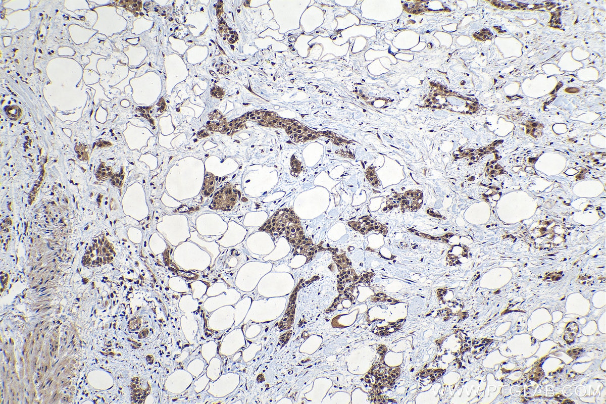 Immunohistochemical analysis of paraffin-embedded human urothelial carcinoma tissue slide using KHC1313 (SMU1 IHC Kit).