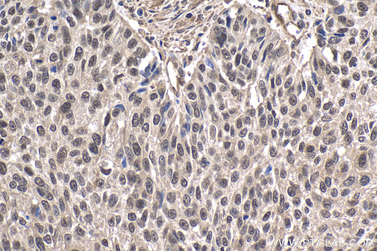 Immunohistochemical analysis of paraffin-embedded human lung cancer tissue slide using KHC1834 (SMYD1 IHC Kit).