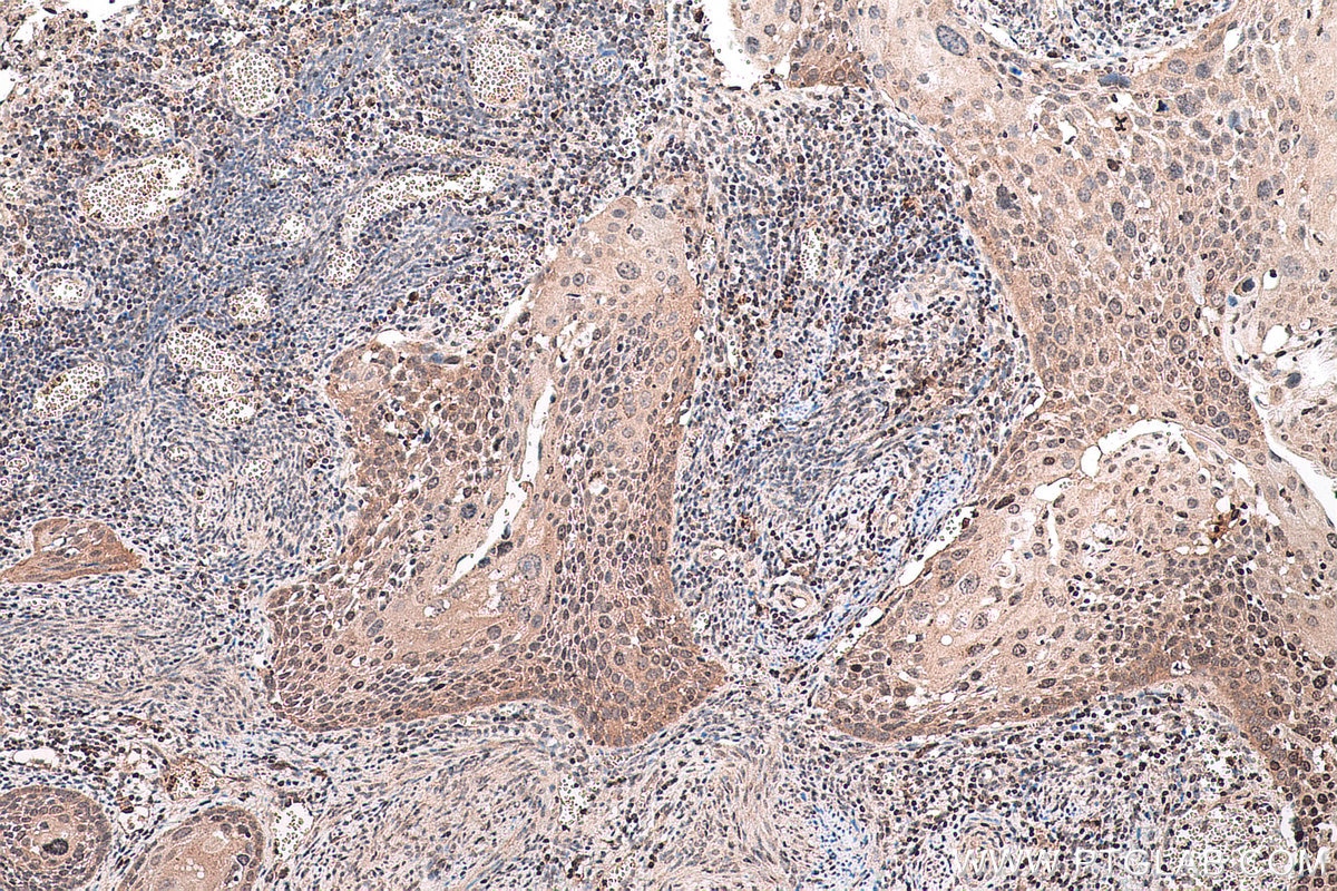 Immunohistochemical analysis of paraffin-embedded human cervical cancer tissue slide using KHC0769 (SMYD2 IHC Kit).