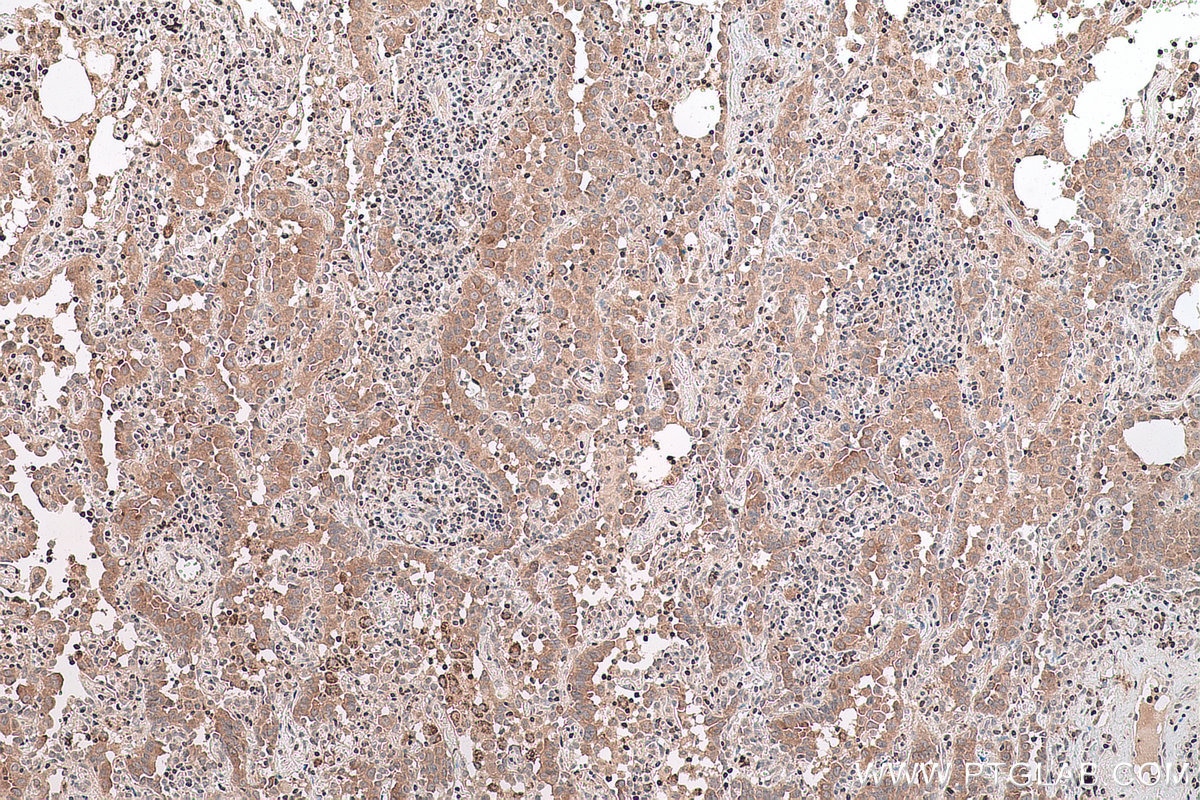 Immunohistochemical analysis of paraffin-embedded human lung cancer tissue slide using KHC0769 (SMYD2 IHC Kit).