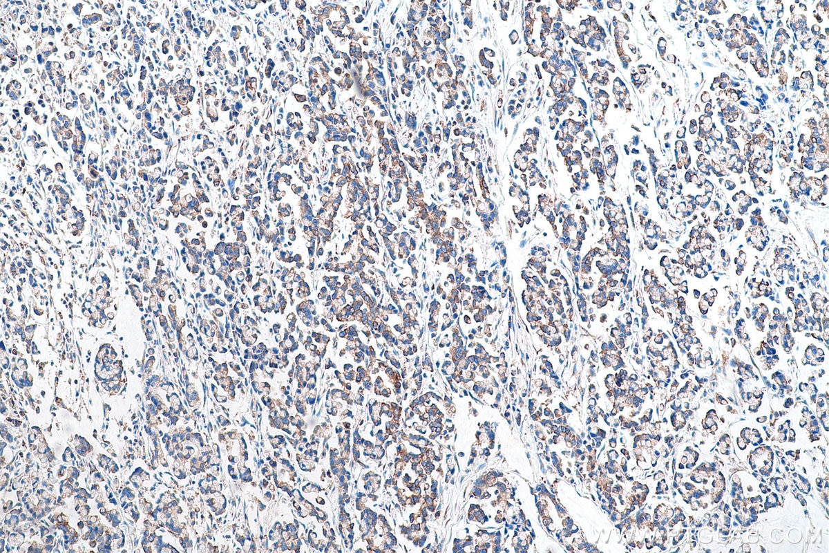 Immunohistochemical analysis of paraffin-embedded human colon cancer tissue slide using KHC0954 (SND1 IHC Kit).