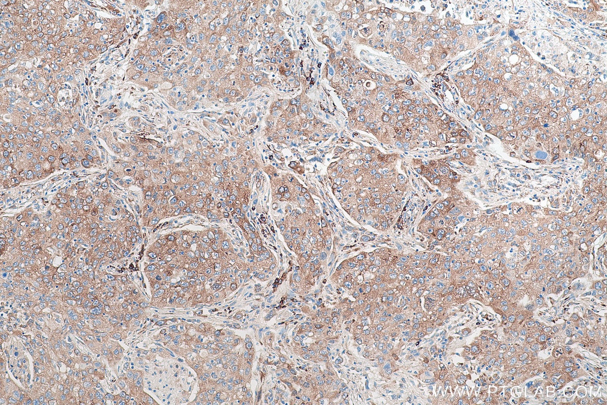Immunohistochemical analysis of paraffin-embedded human lung cancer tissue slide using KHC0954 (SND1 IHC Kit).