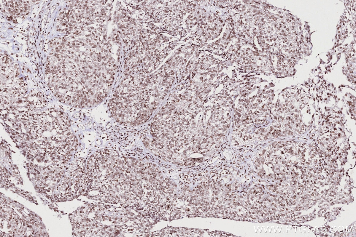 Immunohistochemical analysis of paraffin-embedded human ovary cancer tissue slide using KHC2703 (SNIP1 IHC Kit).