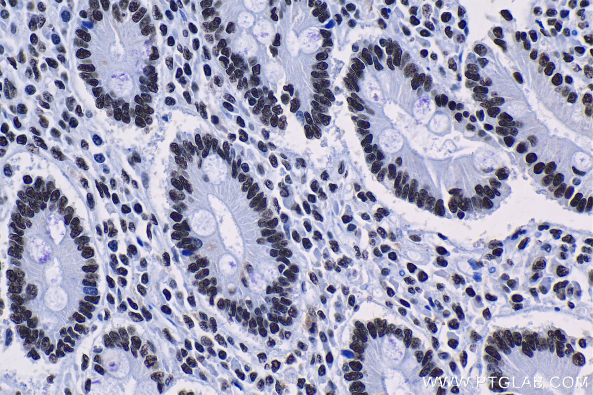 Immunohistochemical analysis of paraffin-embedded human stomach cancer tissue slide using KHC1306 (SNRPA1 IHC Kit).