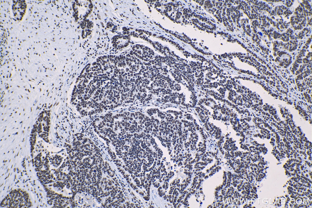 Immunohistochemical analysis of paraffin-embedded human ovary tumor tissue slide using KHC1306 (SNRPA1 IHC Kit).