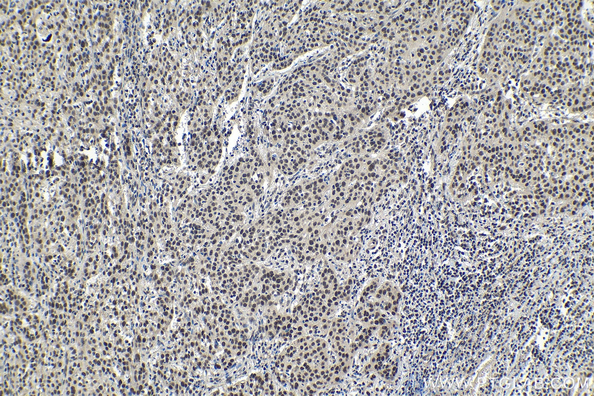 Immunohistochemical analysis of paraffin-embedded human cervical cancer tissue slide using KHC0977 (SNRPB IHC Kit).