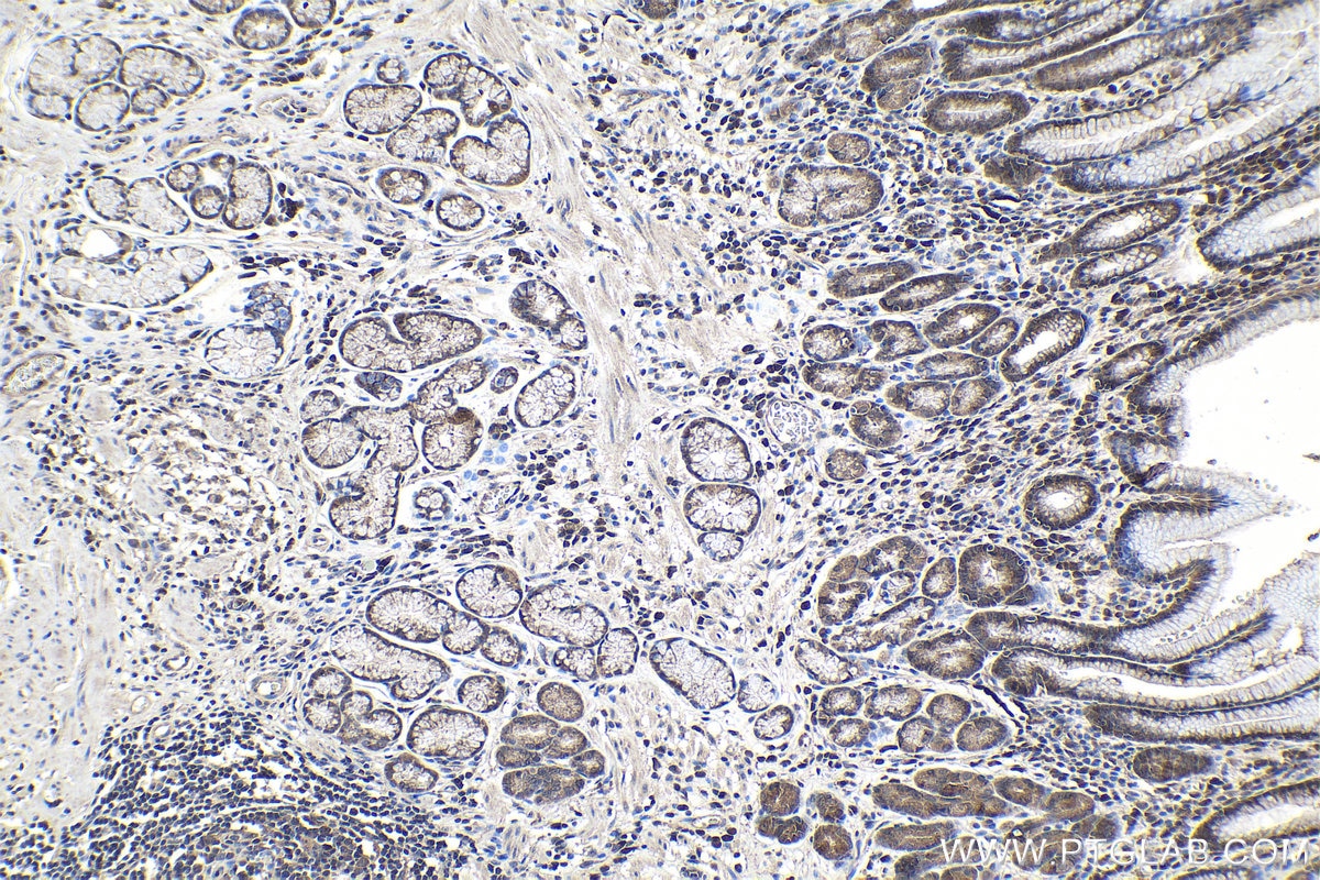 Immunohistochemical analysis of paraffin-embedded human stomach cancer tissue slide using KHC0977 (SNRPB IHC Kit).