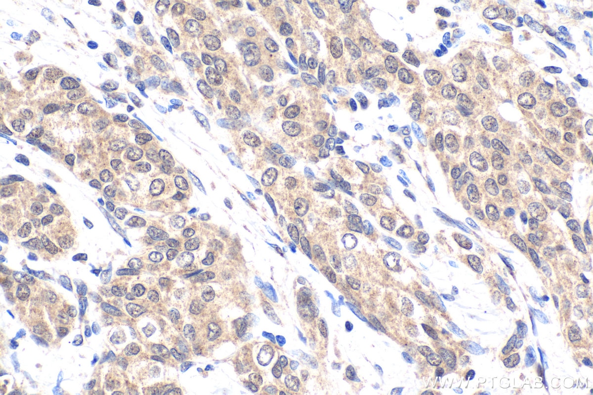Immunohistochemical analysis of paraffin-embedded human urothelial carcinoma tissue slide using KHC1645 (SNRPD3 IHC Kit).