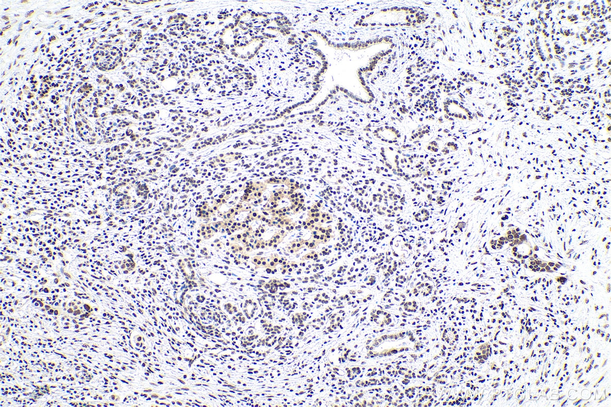 Immunohistochemical analysis of paraffin-embedded human pancreas cancer tissue slide using KHC0834 (SNRPF IHC Kit).