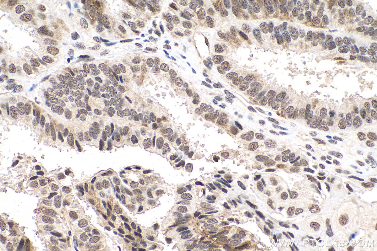 Immunohistochemical analysis of paraffin-embedded human ovary tumor tissue slide using KHC0834 (SNRPF IHC Kit).