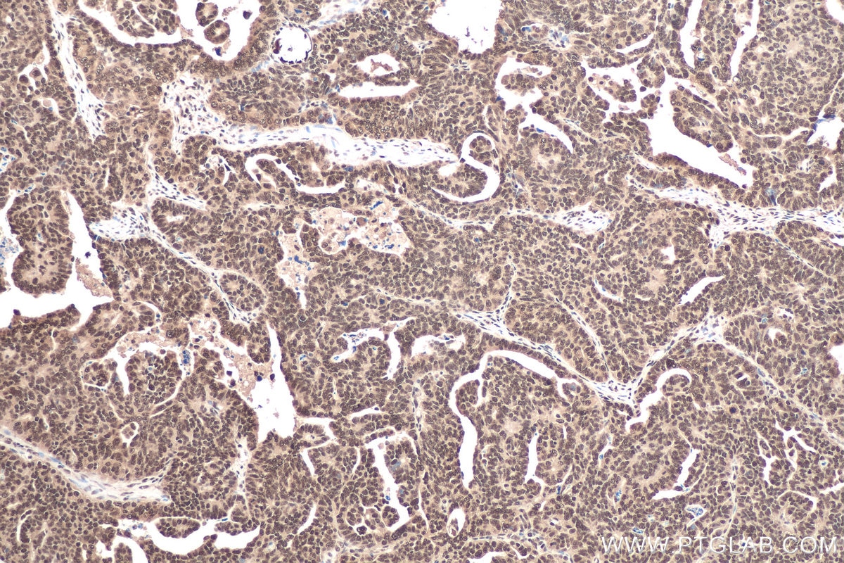Immunohistochemical analysis of paraffin-embedded human ovary tumor tissue slide using KHC0882 (SNRPG IHC Kit).