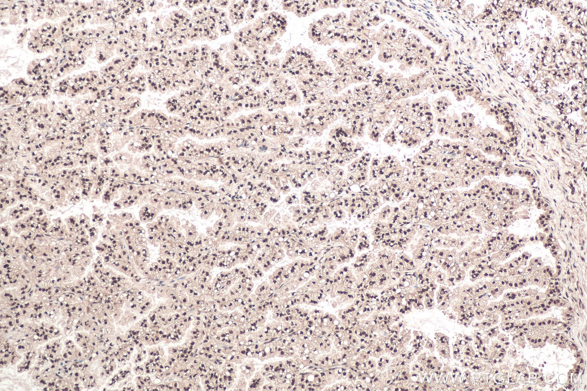 Immunohistochemical analysis of paraffin-embedded human lung cancer tissue slide using KHC0882 (SNRPG IHC Kit).