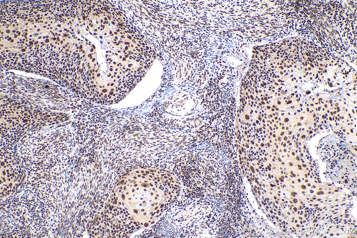 Immunohistochemical analysis of paraffin-embedded human cervical cancer tissue slide using KHC0847 (SNU13/NHP2L1 IHC Kit).