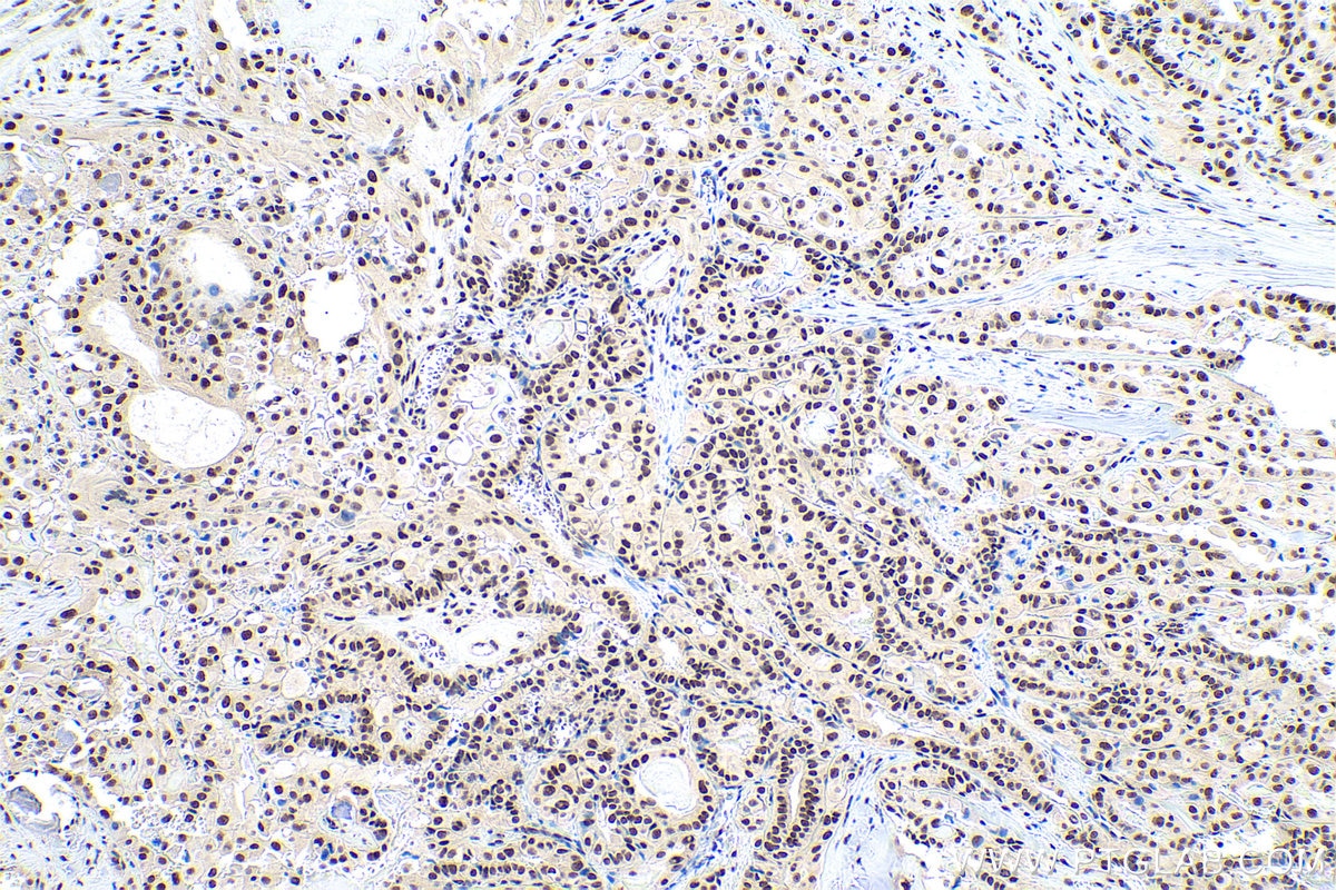 Immunohistochemical analysis of paraffin-embedded human thyroid cancer tissue slide using KHC0847 (SNU13/NHP2L1 IHC Kit).