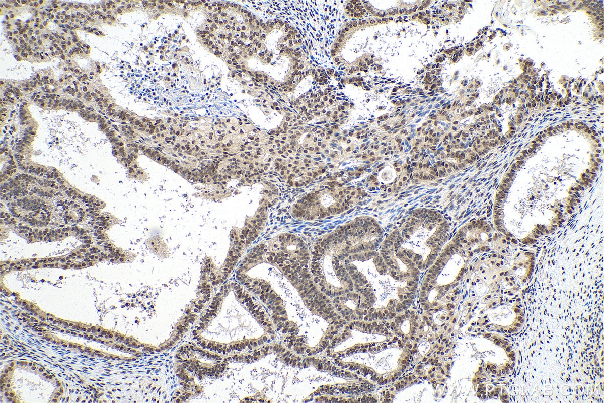 Immunohistochemical analysis of paraffin-embedded human ovary tumor tissue slide using KHC0847 (SNU13/NHP2L1 IHC Kit).