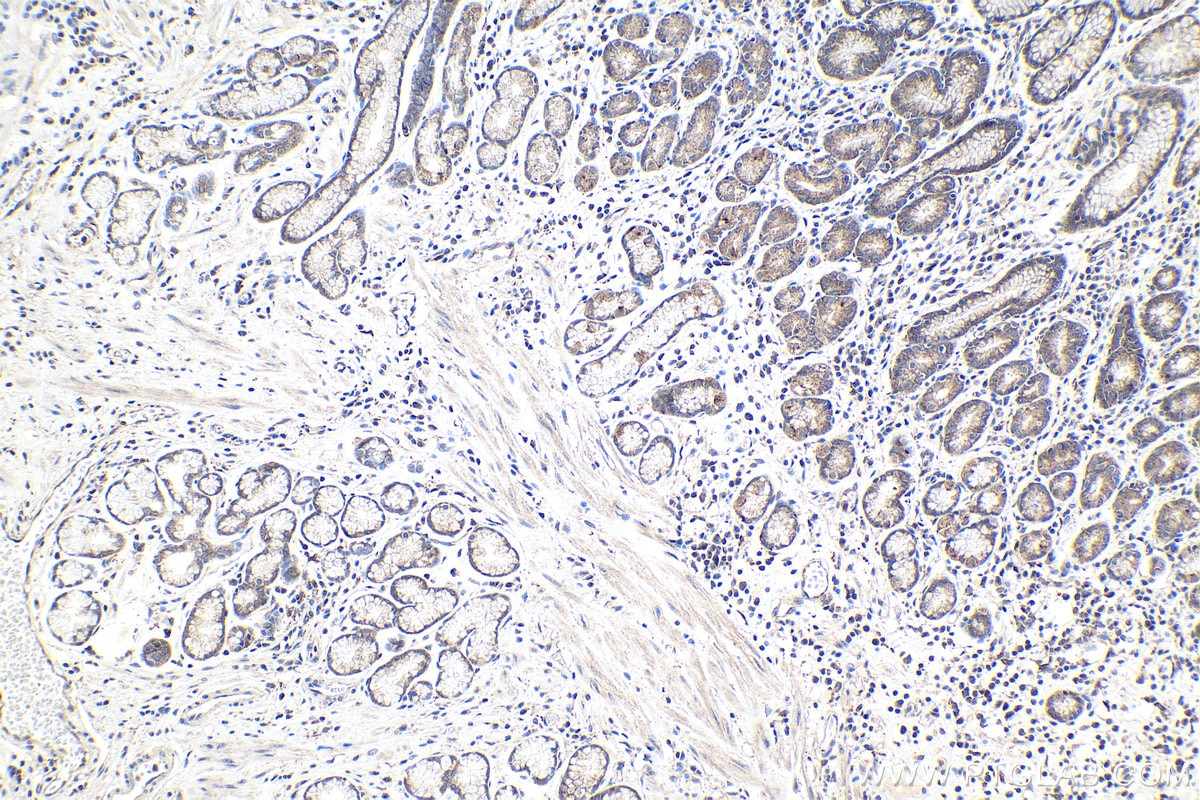 Immunohistochemical analysis of paraffin-embedded human stomach cancer tissue slide using KHC0979 (SNX5 IHC Kit).