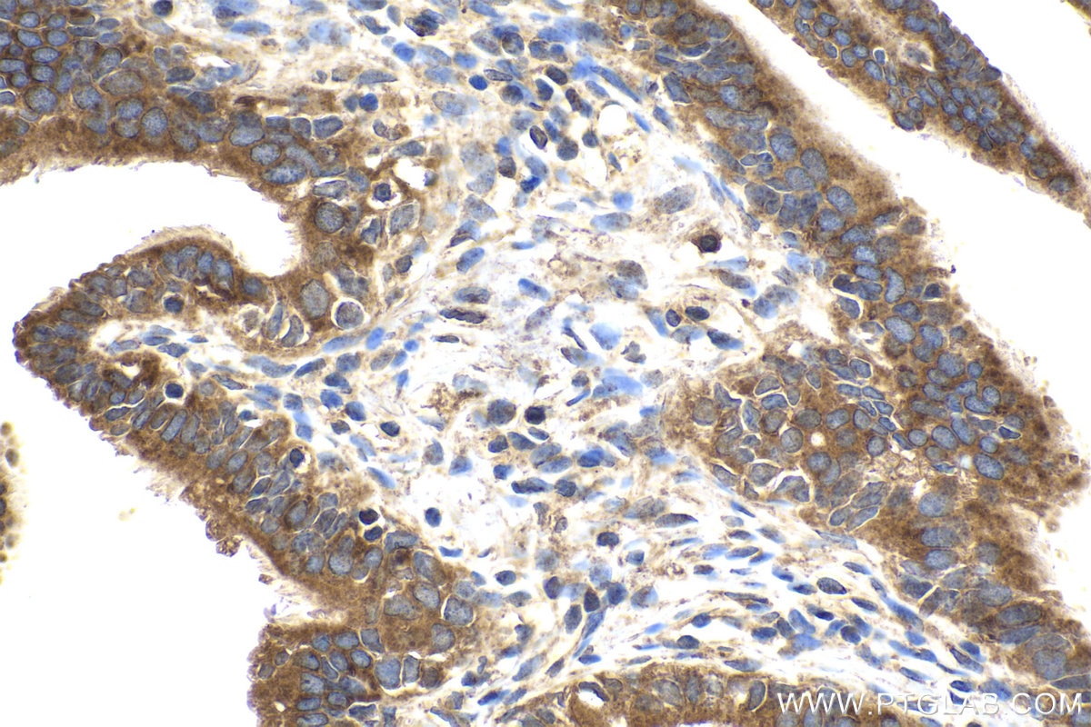 Immunohistochemical analysis of paraffin-embedded human ovary tumor tissue slide using KHC2004 (SNX6 IHC Kit).