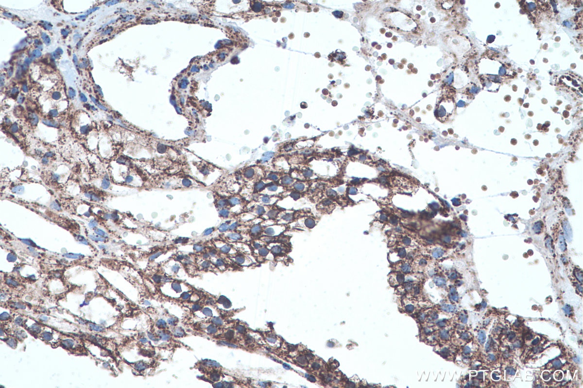 Immunohistochemical analysis of paraffin-embedded human renal cell carcinoma tissue slide using KHC0465 (SOD2 IHC Kit).