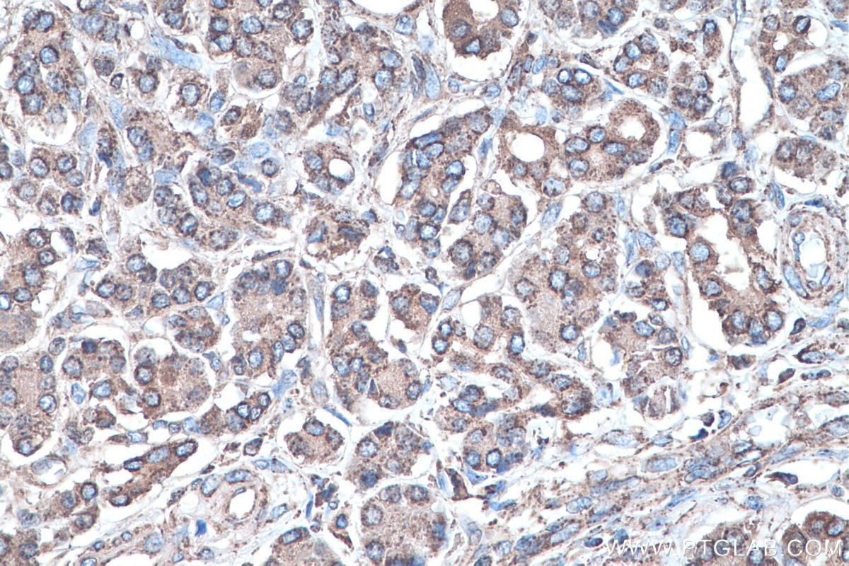 Immunohistochemical analysis of paraffin-embedded human pancreas cancer tissue slide using KHC0465 (SOD2 IHC Kit).