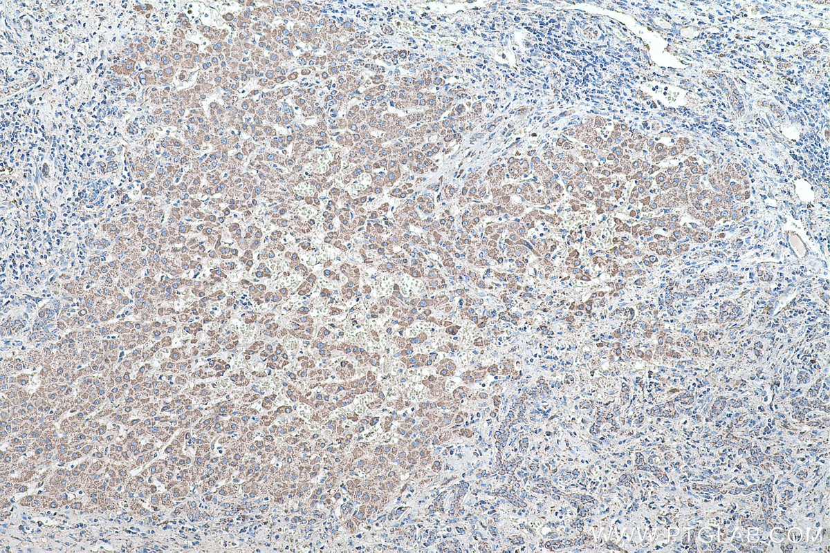 Immunohistochemical analysis of paraffin-embedded human liver cancer tissue slide using KHC0465 (SOD2 IHC Kit).