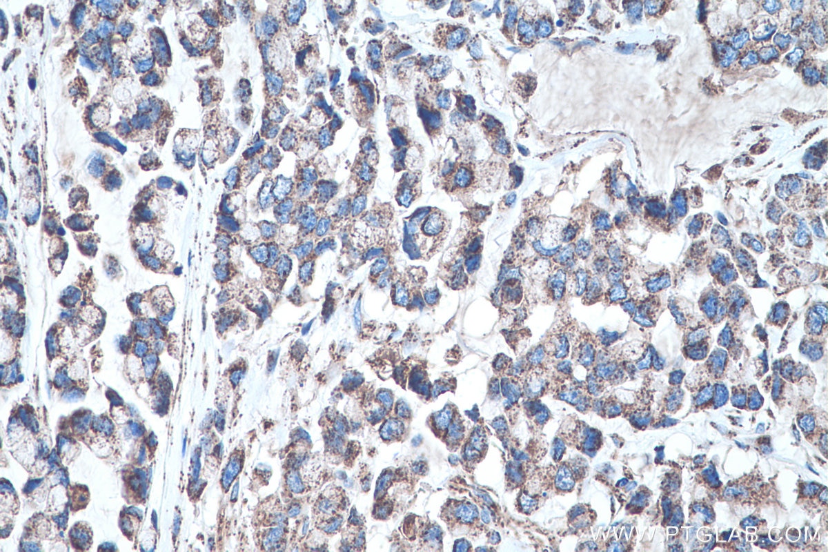 Immunohistochemical analysis of paraffin-embedded human colon cancer tissue slide using KHC0465 (SOD2 IHC Kit).