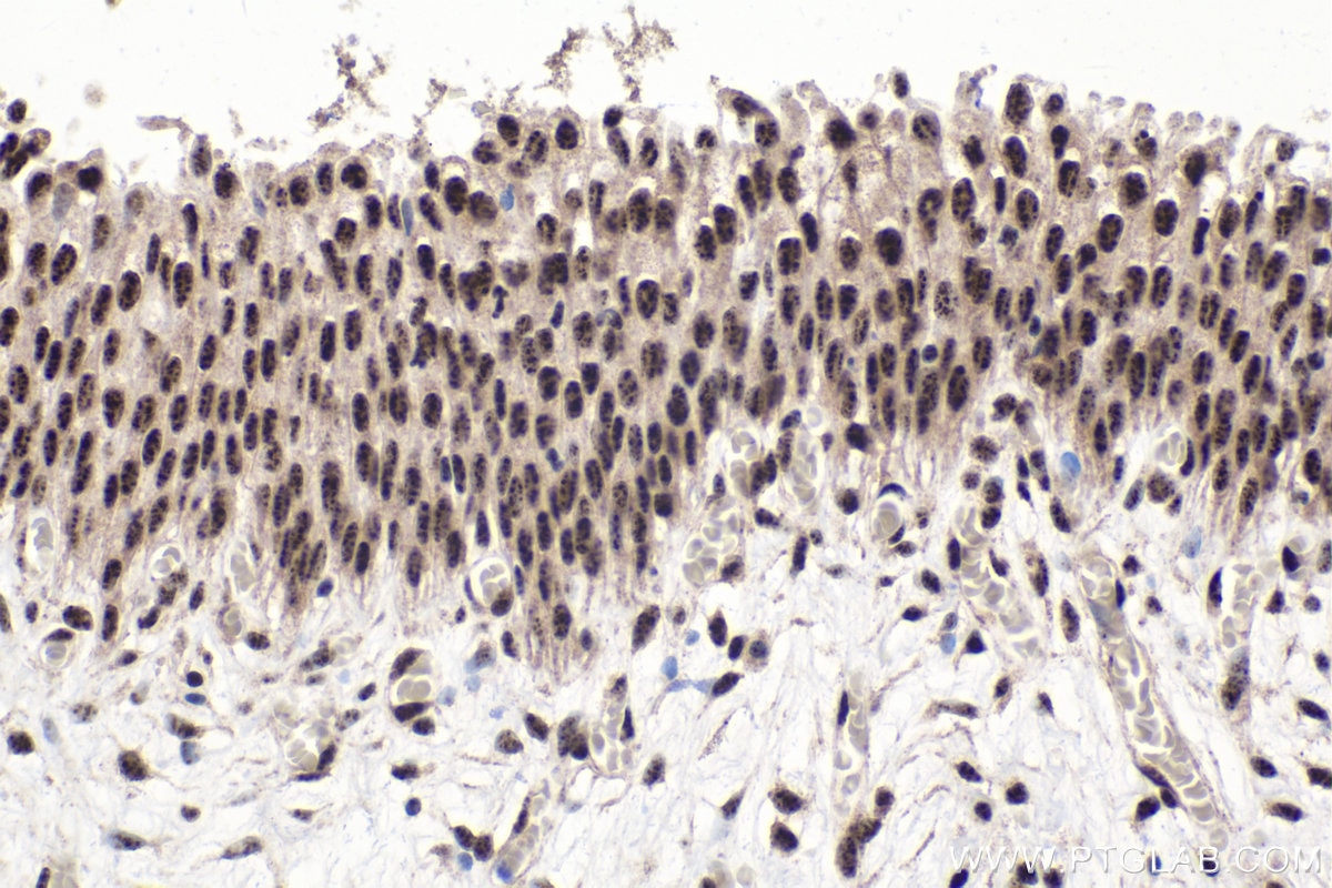 Immunohistochemical analysis of paraffin-embedded human urothelial carcinoma tissue slide using KHC1555 (SON IHC Kit).