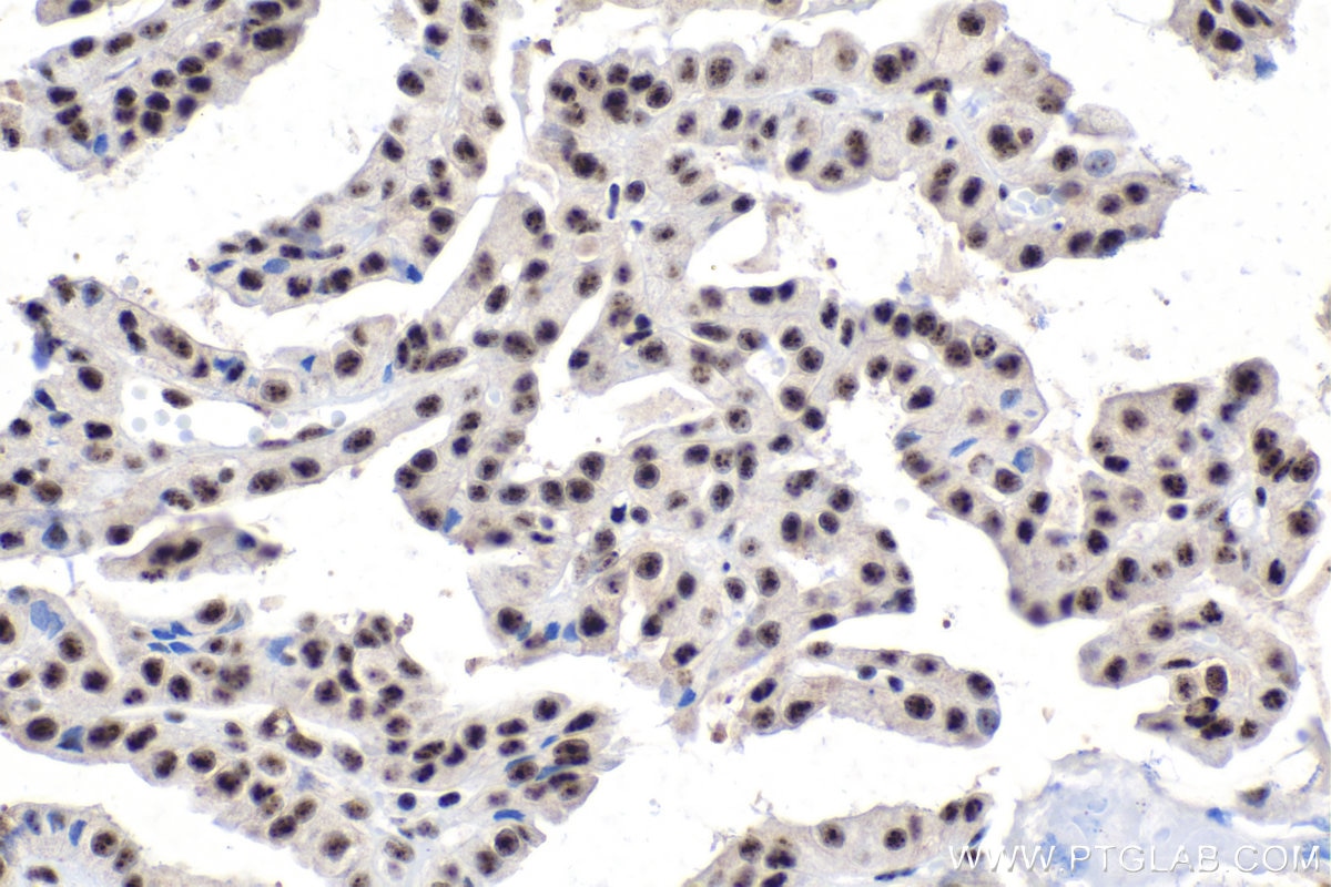 Immunohistochemical analysis of paraffin-embedded human thyroid cancer tissue slide using KHC1555 (SON IHC Kit).