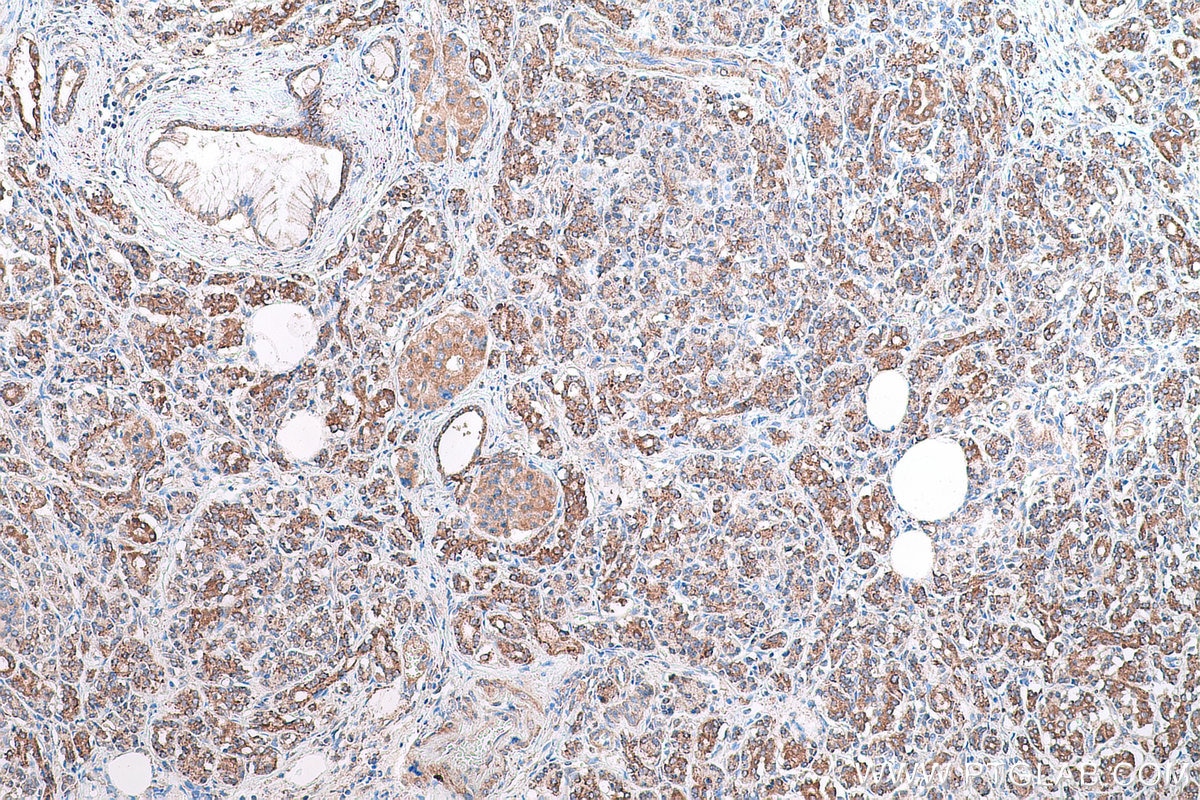 Immunohistochemical analysis of paraffin-embedded human pancreas cancer tissue slide using KHC0829 (SORBS2 IHC Kit).