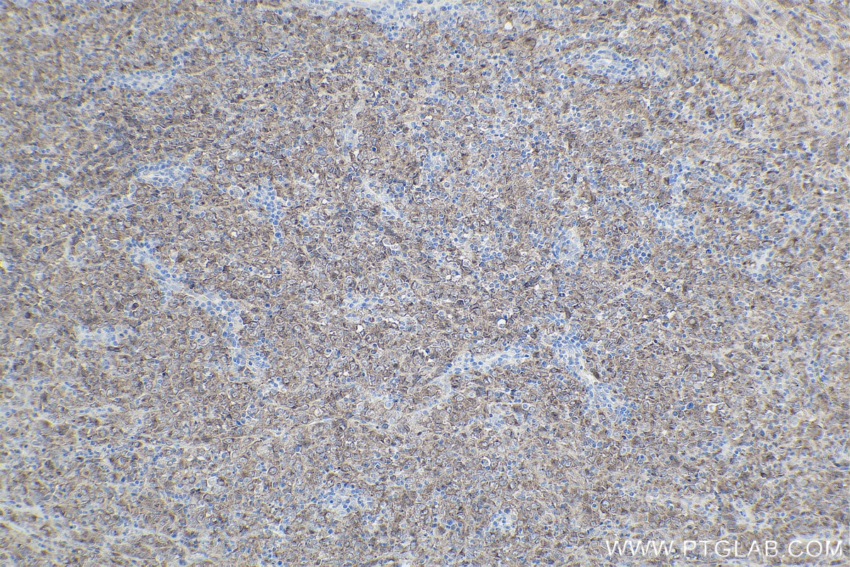 Immunohistochemical analysis of paraffin-embedded human malignant melanoma tissue slide using KHC1889 (SORT1 IHC Kit).
