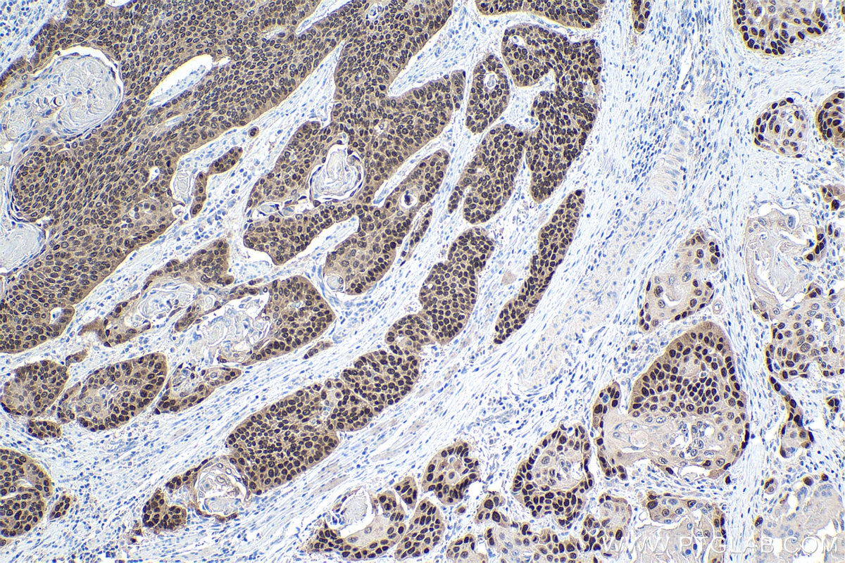 Immunohistochemical analysis of paraffin-embedded human oesophagus cancer tissue slide using KHC1461 (SOX15 IHC Kit).