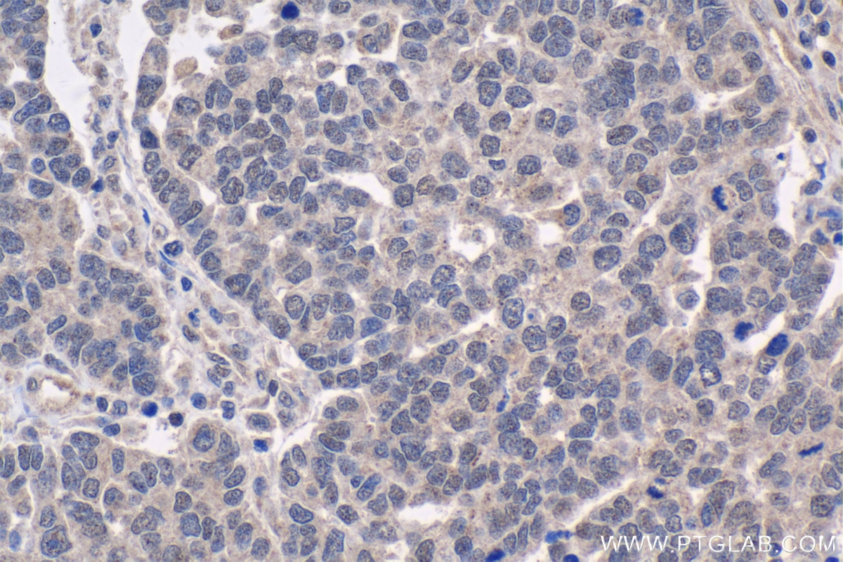 Immunohistochemical analysis of paraffin-embedded human ovary tumor tissue slide using KHC1337 (SOX6 IHC Kit).