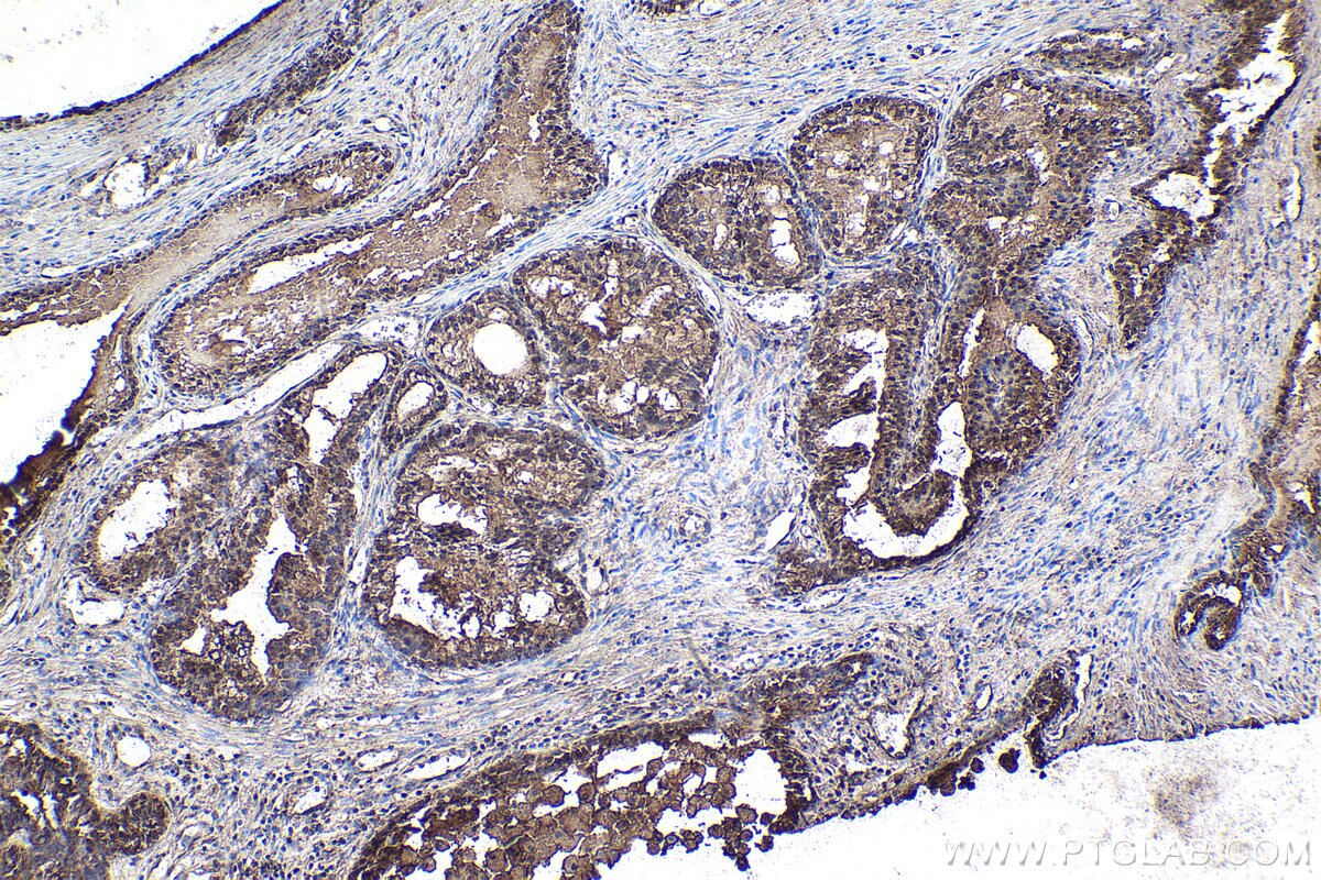 Immunohistochemical analysis of paraffin-embedded human prostate cancer tissue slide using KHC1903 (SOX7 IHC Kit).