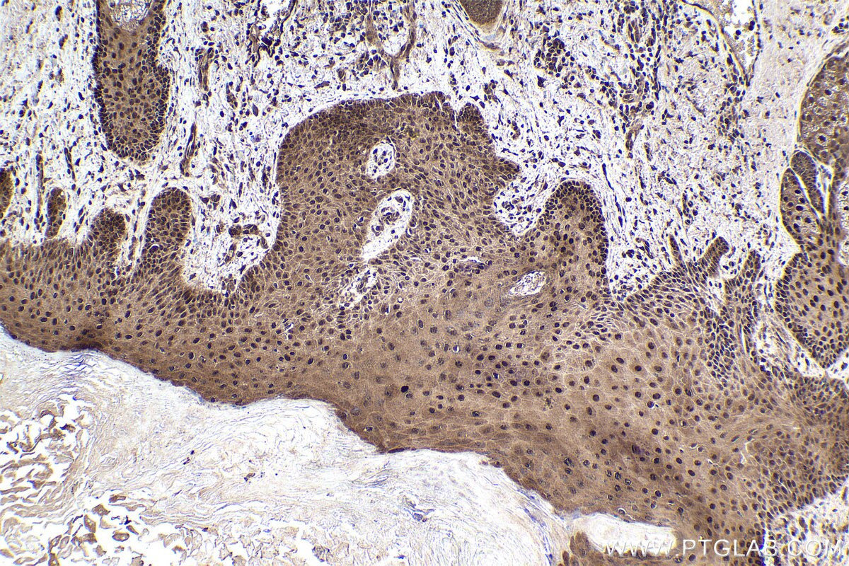 Immunohistochemical analysis of paraffin-embedded human skin cancer tissue slide using KHC1903 (SOX7 IHC Kit).