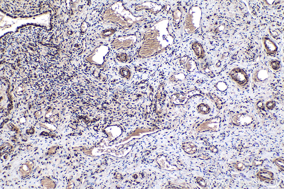 Immunohistochemical analysis of paraffin-embedded human cervical cancer tissue slide using KHC1513 (SP1 IHC Kit).