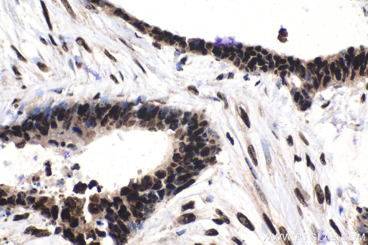 Immunohistochemical analysis of paraffin-embedded human urothelial carcinoma tissue slide using KHC1513 (SP1 IHC Kit).