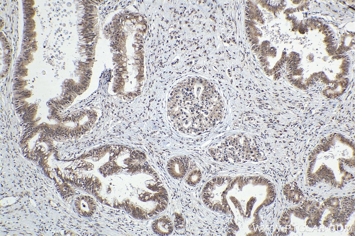 Immunohistochemical analysis of paraffin-embedded human pancreas cancer tissue slide using KHC1561 (SP100 IHC Kit).